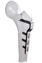 Placa Angulada Femoral