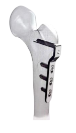 Placa Angulada Femoral